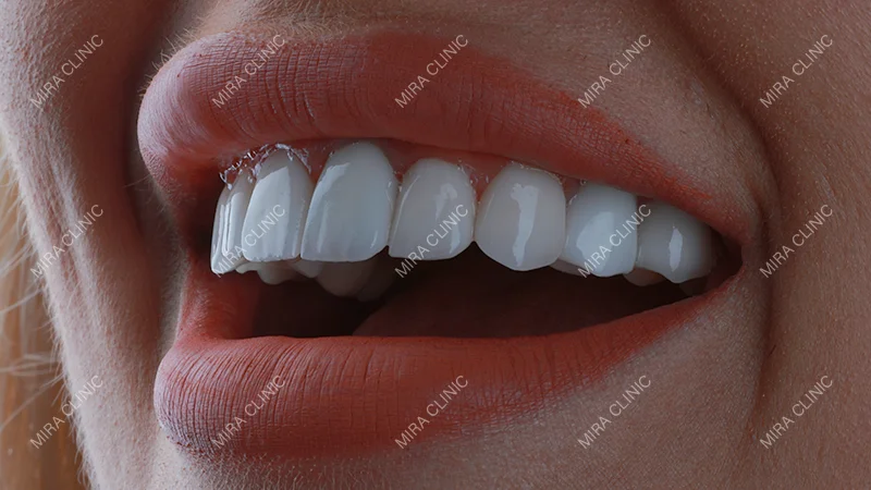 Veneers After Braces